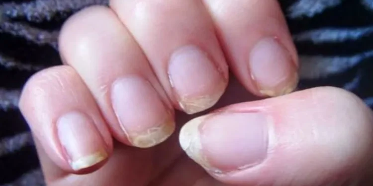 علامة على الأظافر.. مؤشر مبكر لارتفاع نسبة الكوليسترول