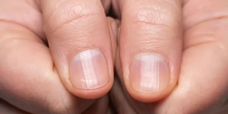 الخطوط على أظافرك.. “أسرار صحية” مرتبطة بالعمر