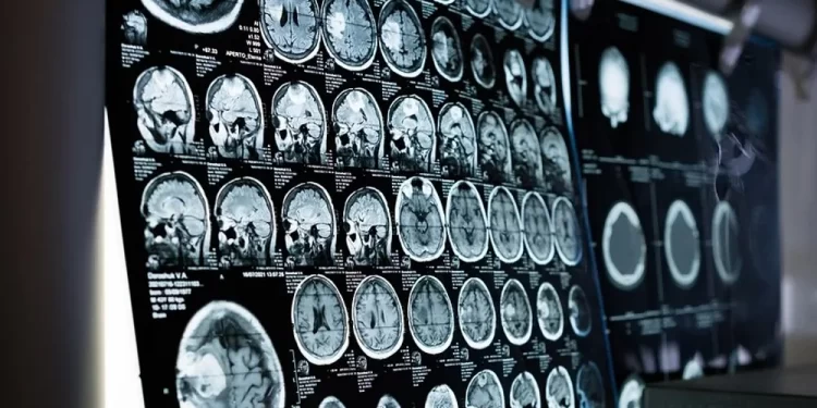 عارض ليلي تتعرض له النساء.. مؤشر على الإصابة بسكتة دماغية