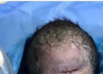 صور صادمة لولادة طفل بعين واحدة في العراق.. والطب يوضح